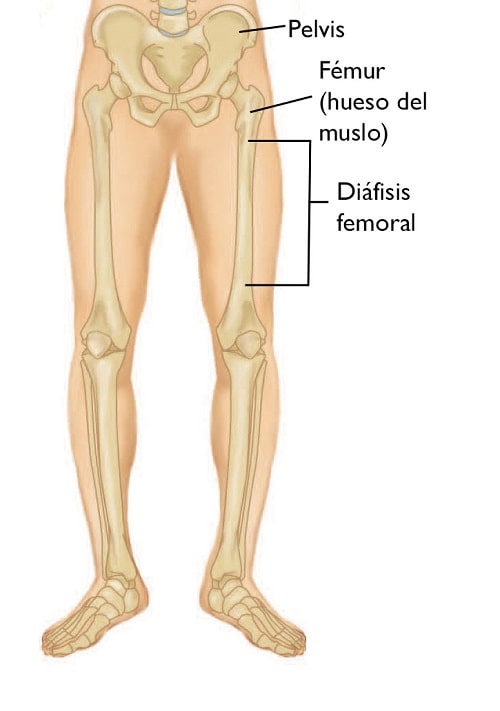 péndulo superávit inyectar Fracturas de la diáfisis femoral (ruptura del hueso del muslo) (Femur Shaft  Fractures (Broken Thighbone)) - OrthoInfo - AAOS