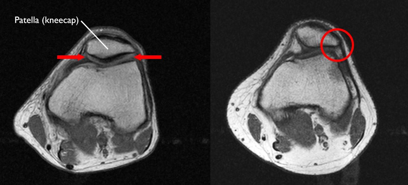 Patellar Tracking Disorders, Knee, Health