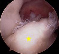 Osteoartritis de rodilla (Knee Osteoarthritis) - OrthoInfo - AAOS