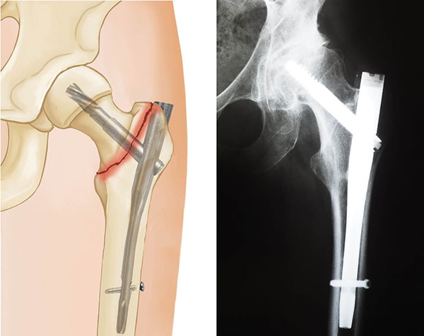 hip fracture repair