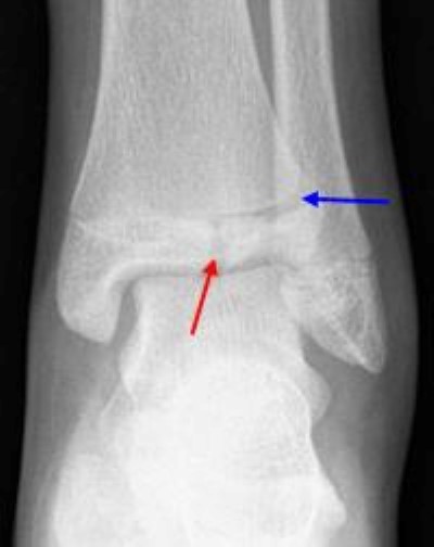 Ankle Fractures In Children Orthoinfo Aaos