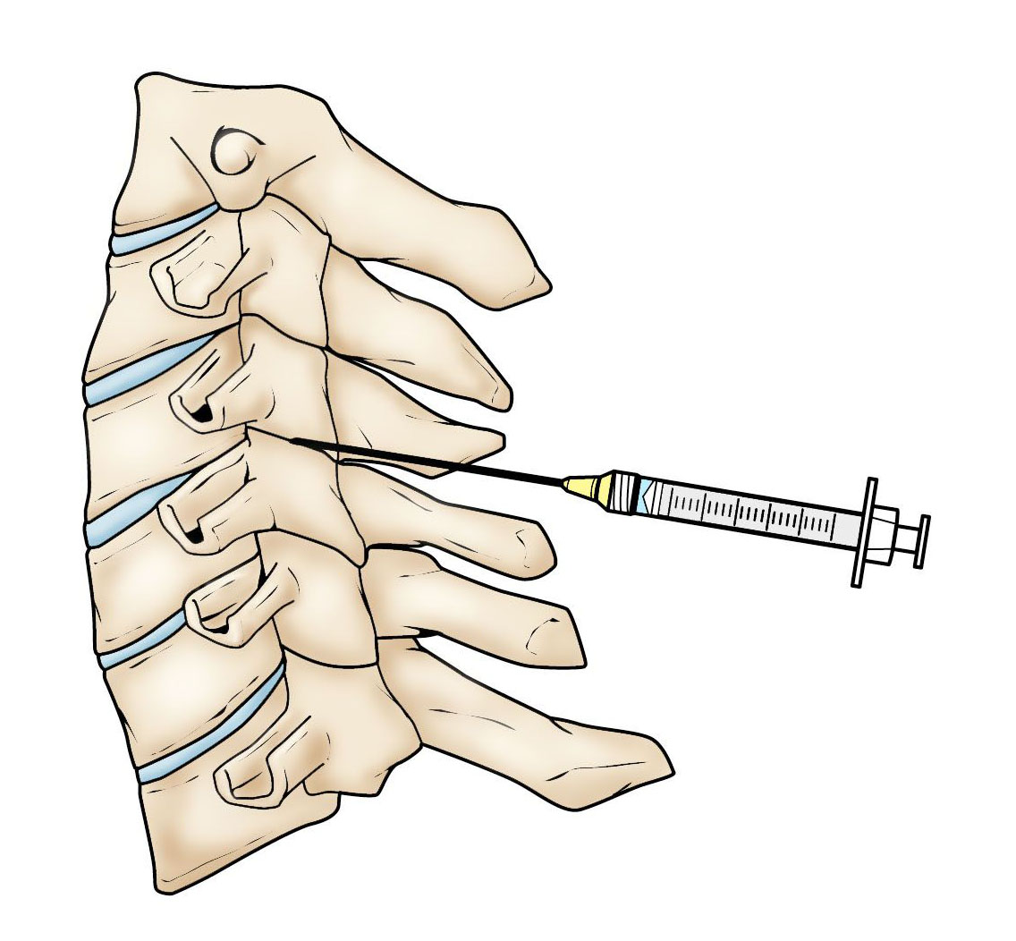 spinal facet injections