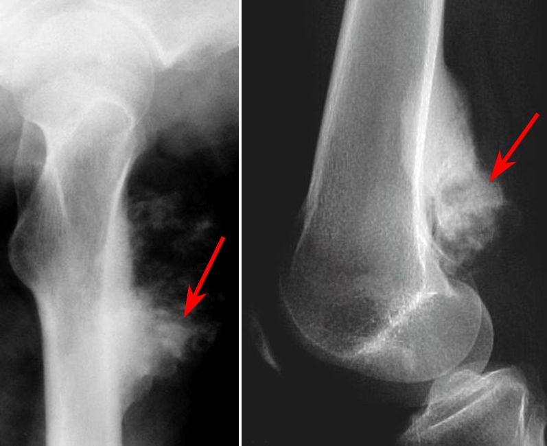 Osteosarcomas periósticos y perostales