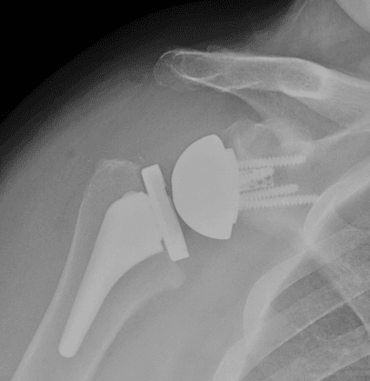 Reverse total shoulder replacement
