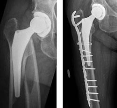 x-ray of periprosthetic hip fracture and surgical fixation