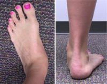 Flexible Flatfoot in Children - OrthoInfo - AAOS