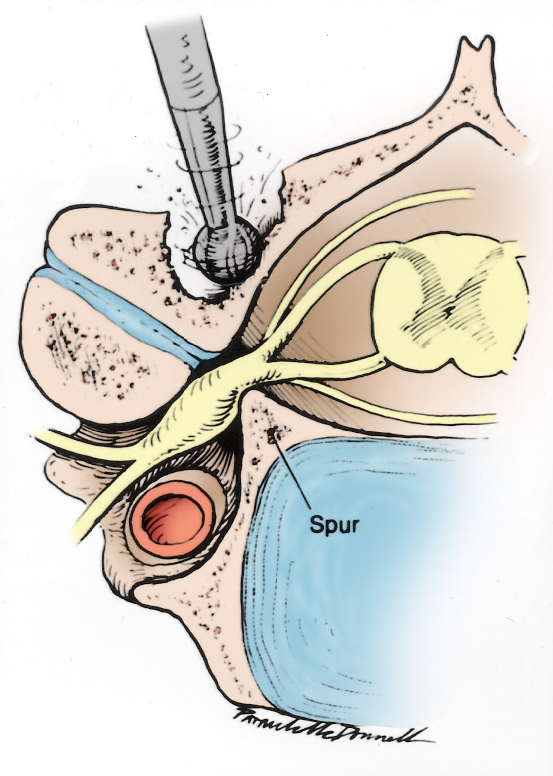 Radiculopatía cervical (nervio pinzado) (Cervical Radiculopathy (Pinched  Nerve)) - OrthoInfo - AAOS