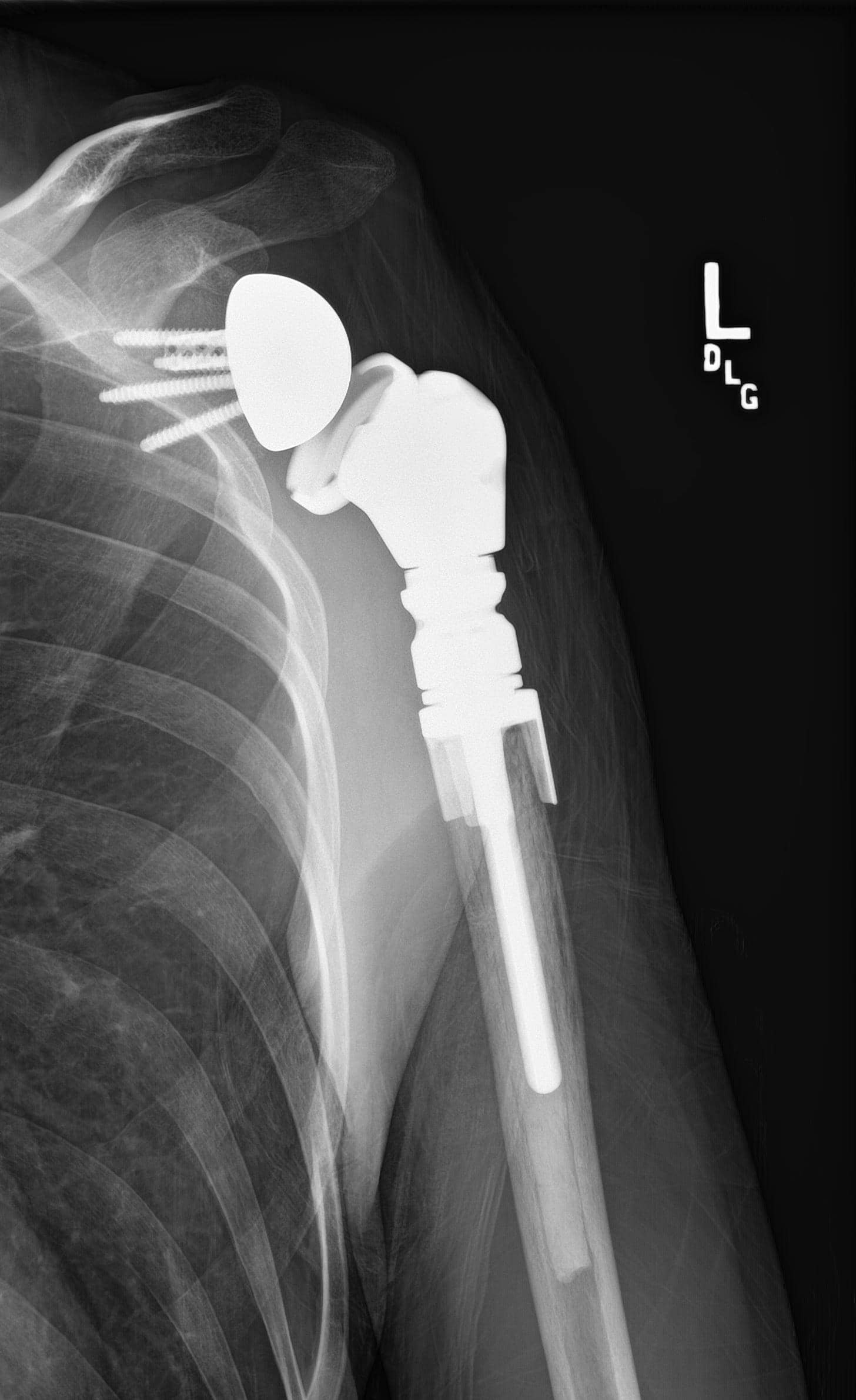 upper humeral prosthetic replacement