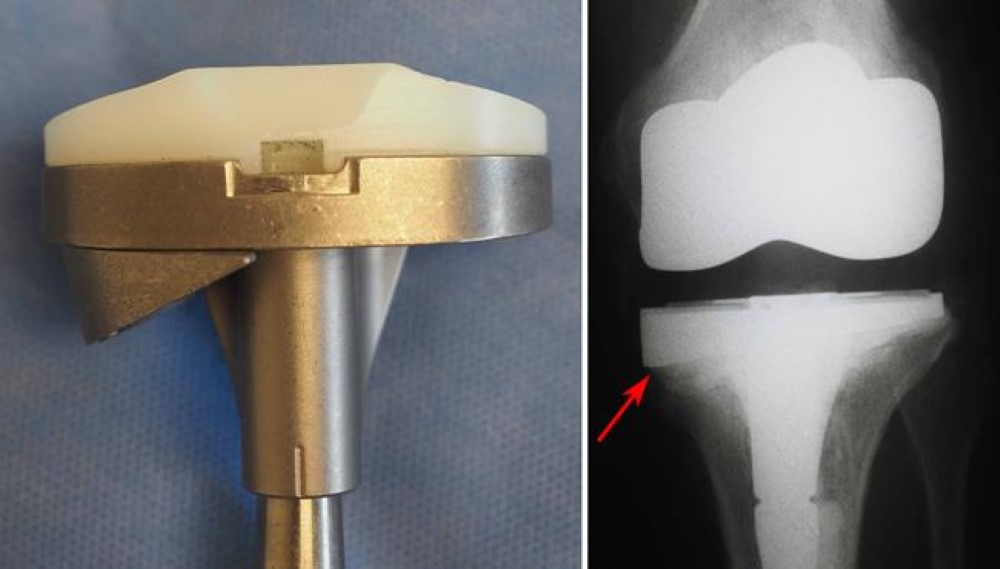 PARTS OF TOTAL KNEE REPLACEMENT