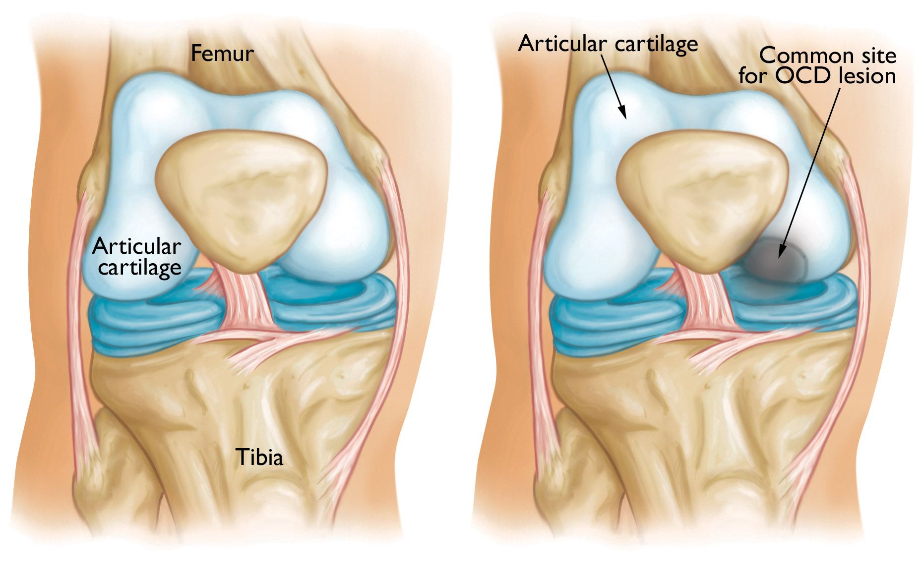 osteochondritis dissecans of the knee