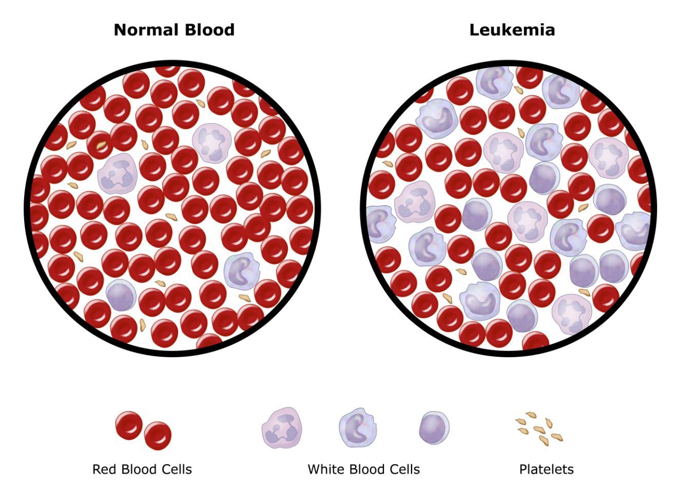 how quickly does leukemia develop