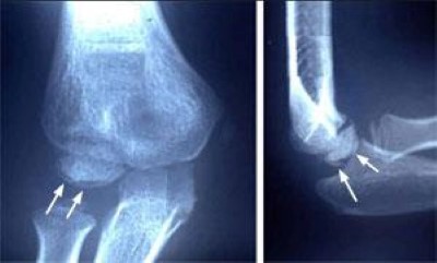 X-ray showing effects of excessive throwing