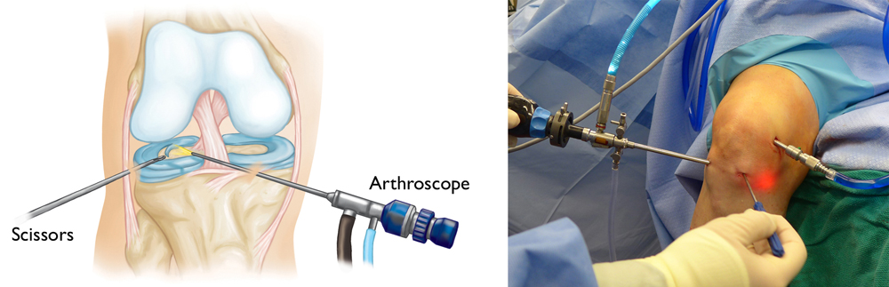 artroscopia de rodilla