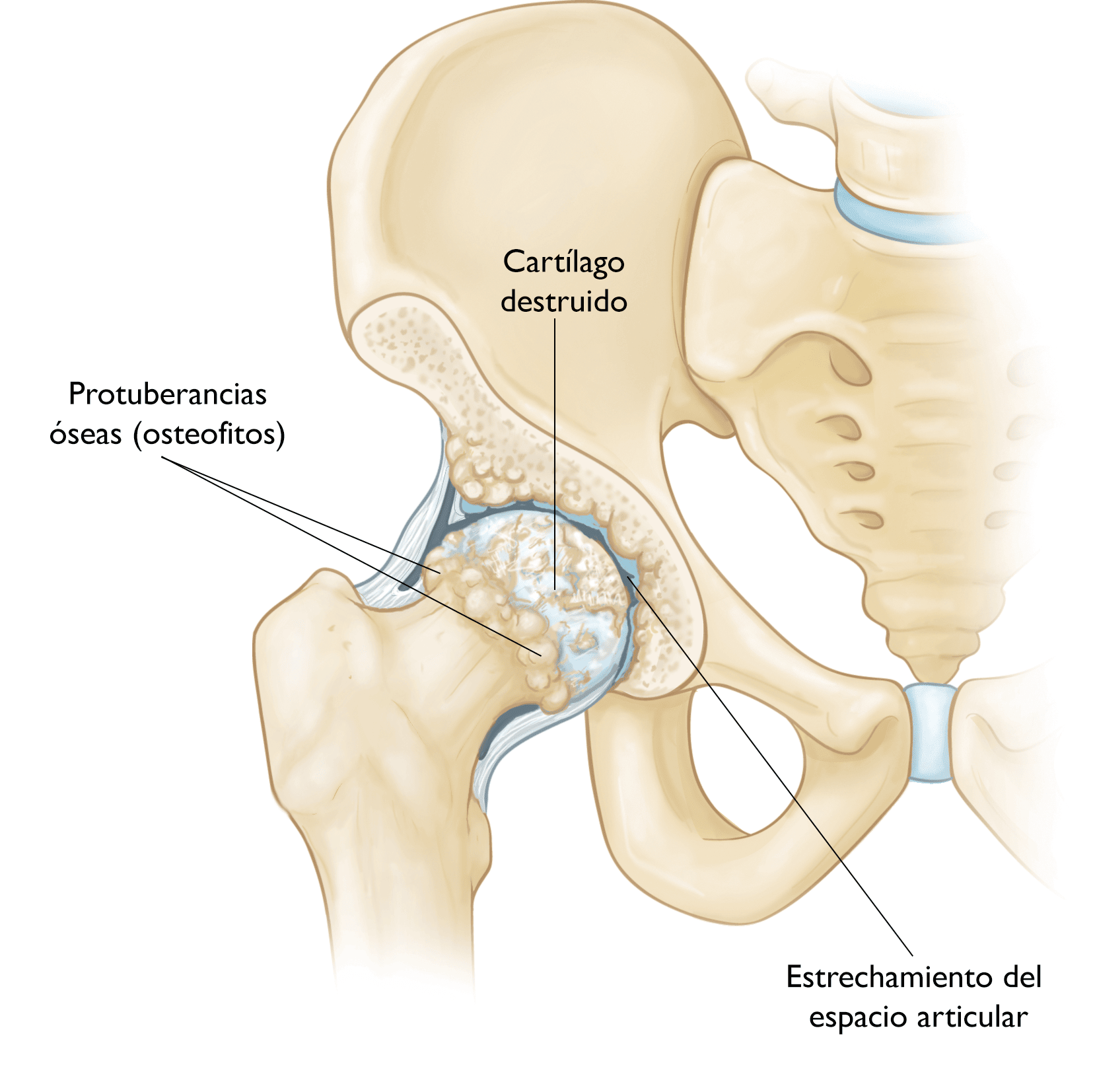 Cómo curar la artrosis de rodilla