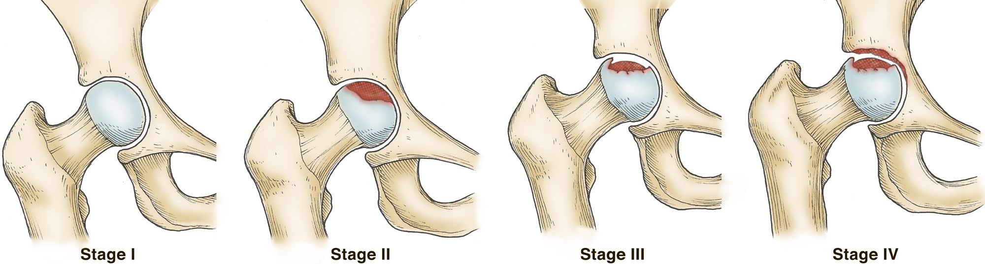 Stages of osteonecrosis of the hip