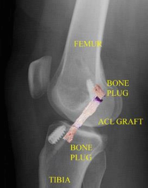 Image result for mri of acl tear