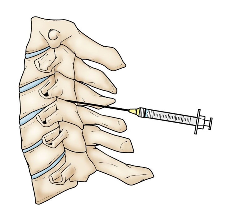 Columna Activa :: Razones de rigidez en el cuello