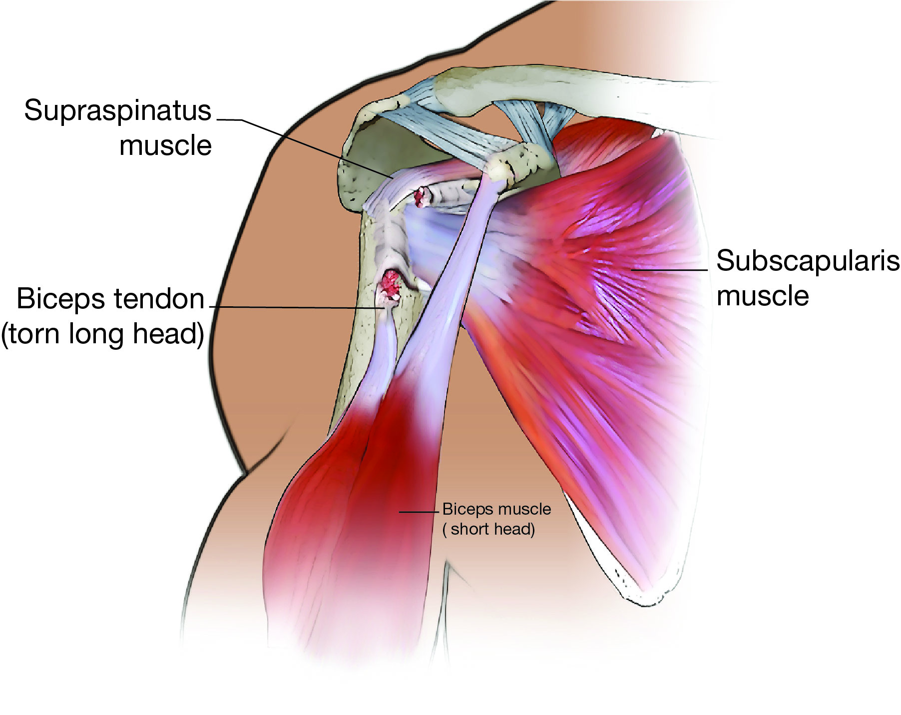 Biceps tendon tear