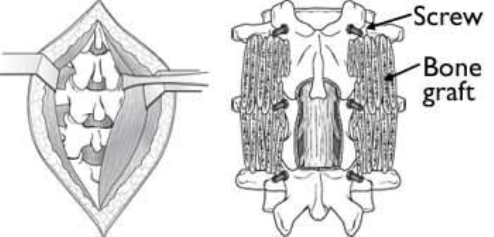 spine decompression and bone graft