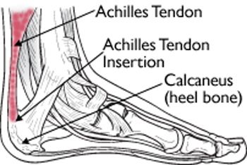 Achilles tendon deals pain heel