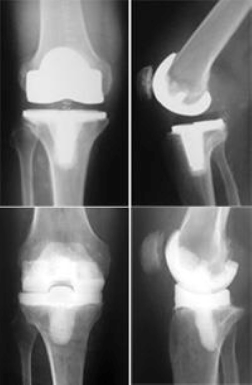 Joint Replacement Infection OrthoInfo AAOS