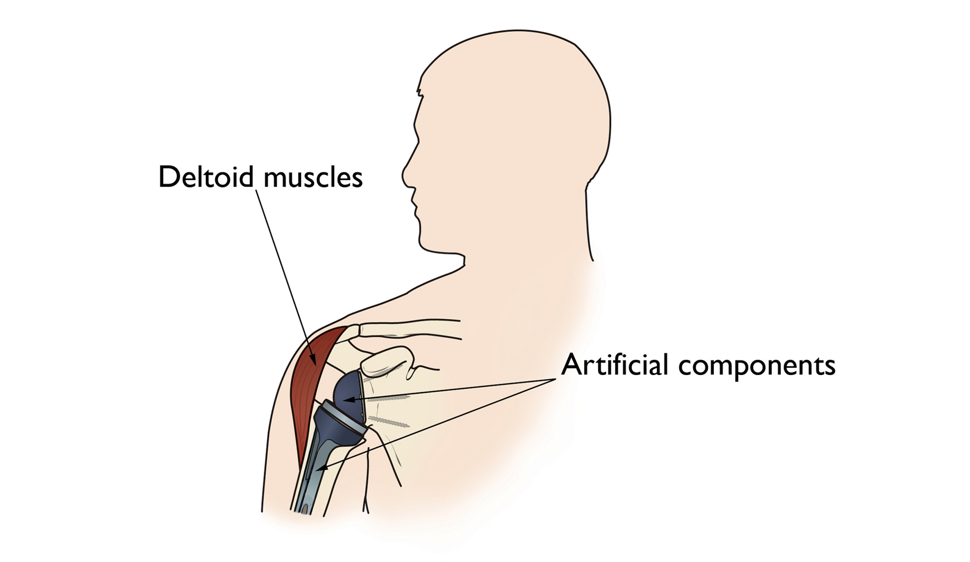 reverse total shoulder illustration