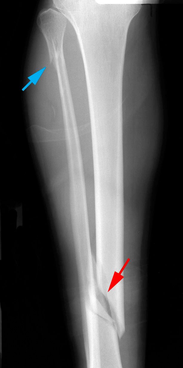 fractured fibula and tibia