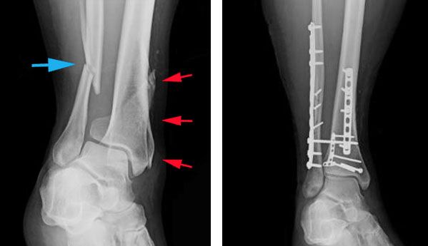 fractured fibula and tibia