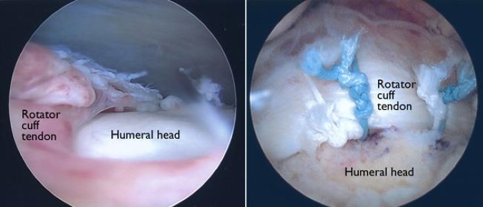 rotator cuff surgery recovery time