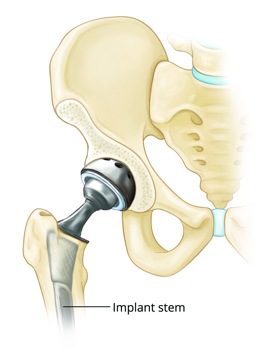 Fracture After Total Hip Replacement - OrthoInfo - AAOS