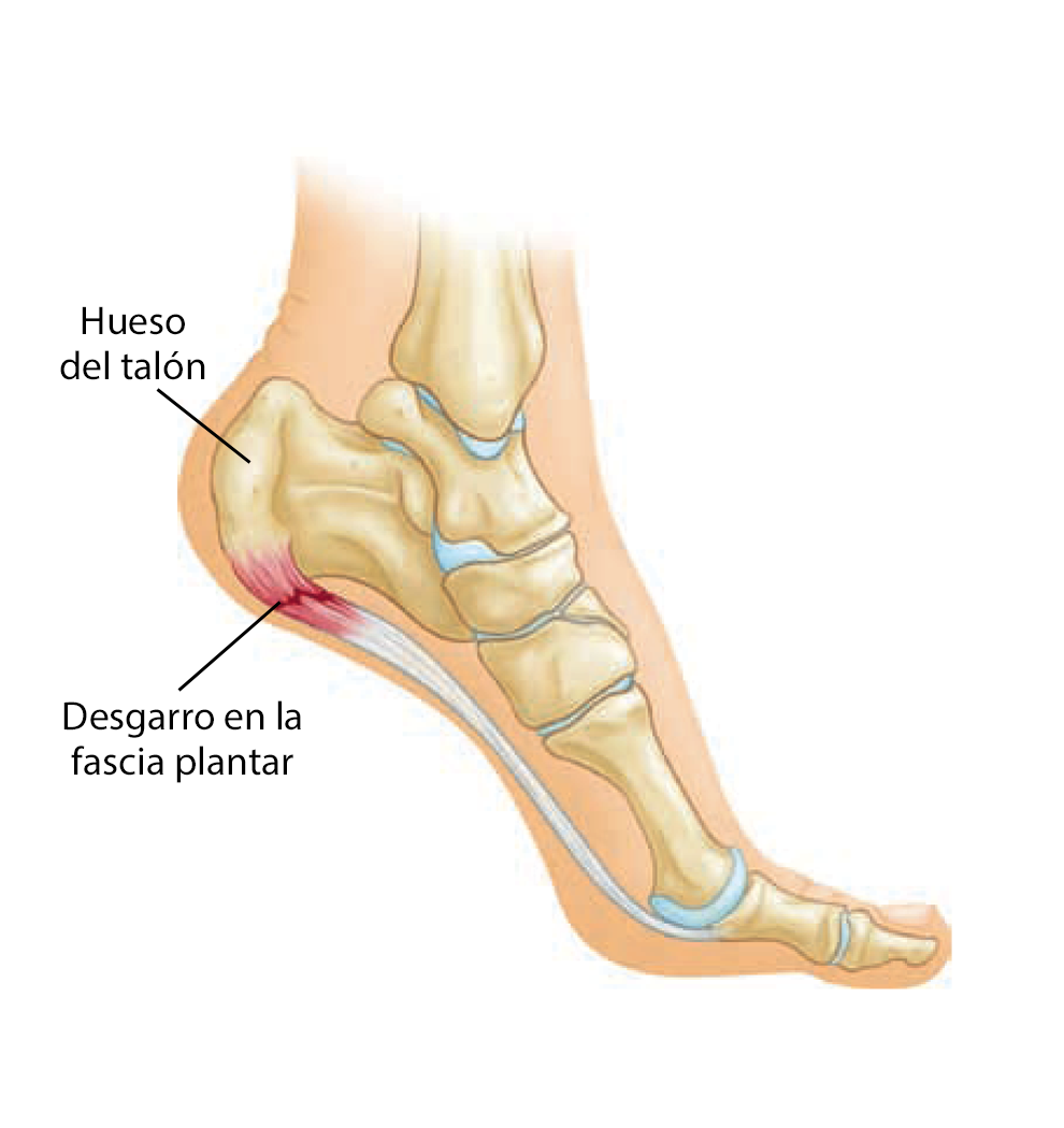 Fascitis plantar y espolón 