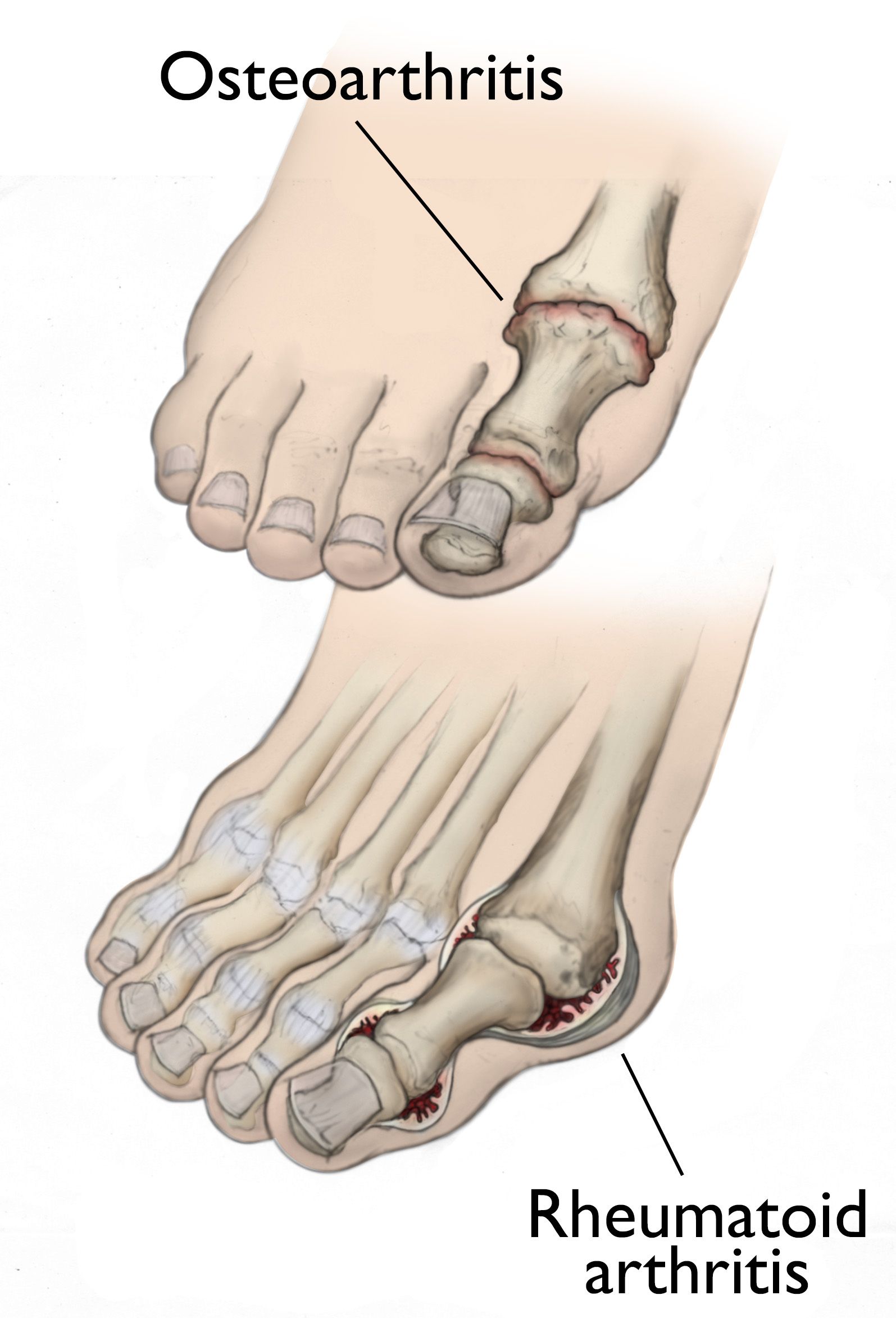 Arthritis of the Foot and Ankle - OrthoInfo - AAOS