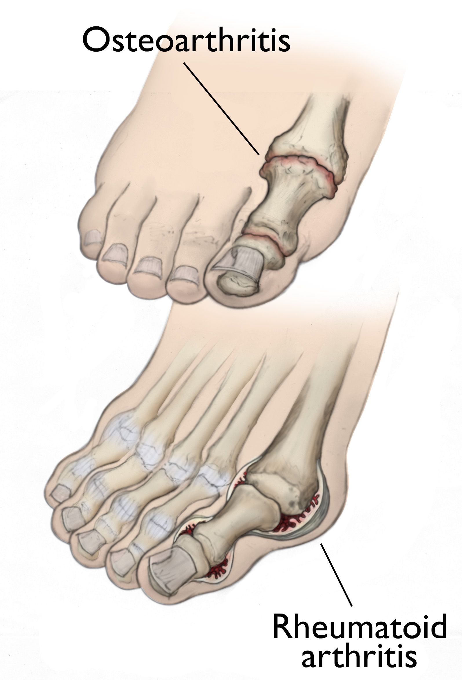 Pain On Top Of Foot Arthritis On Sale Emergencydentistry