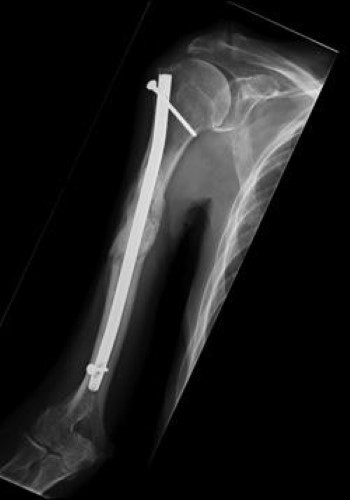 intramedullary rod in humerus