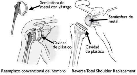 Osteoartritis de rodilla (Knee Osteoarthritis) - OrthoInfo - AAOS