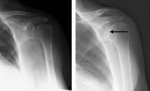 X-ray of osteoarthritis of the shoulder