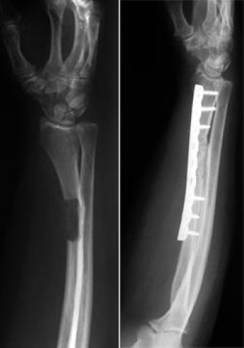 tumor en antebrazo estabilizado con placa y tornillos