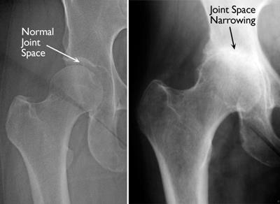 normal hip and hip with inflammatory arthritis