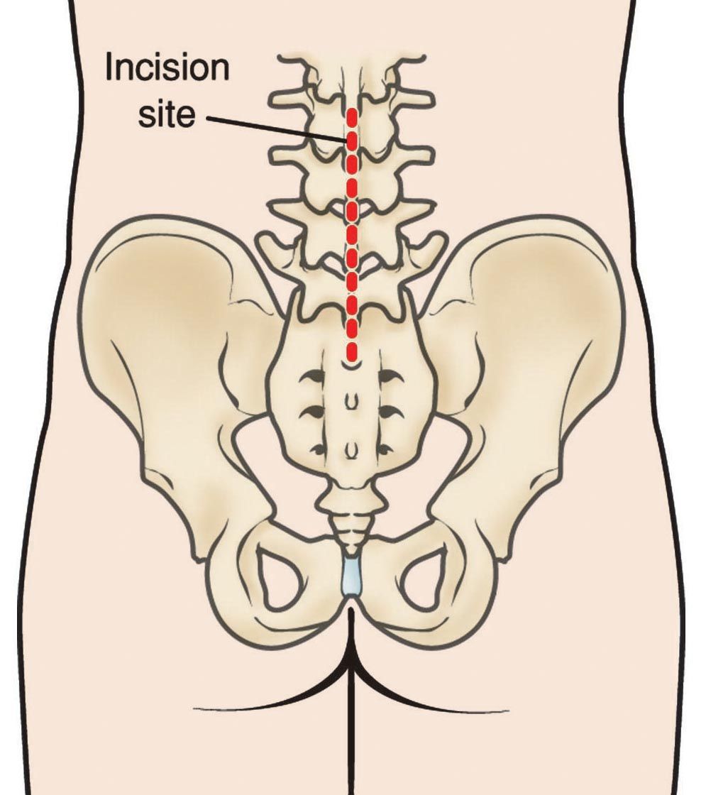 incision site for lumbar spine surgery