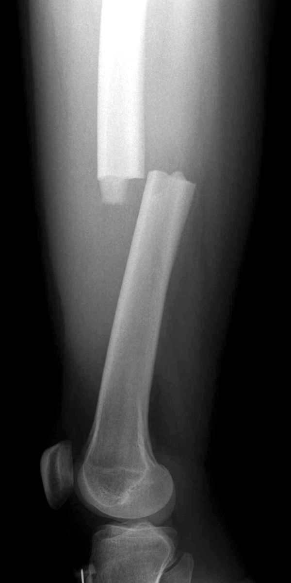 broken femur x ray