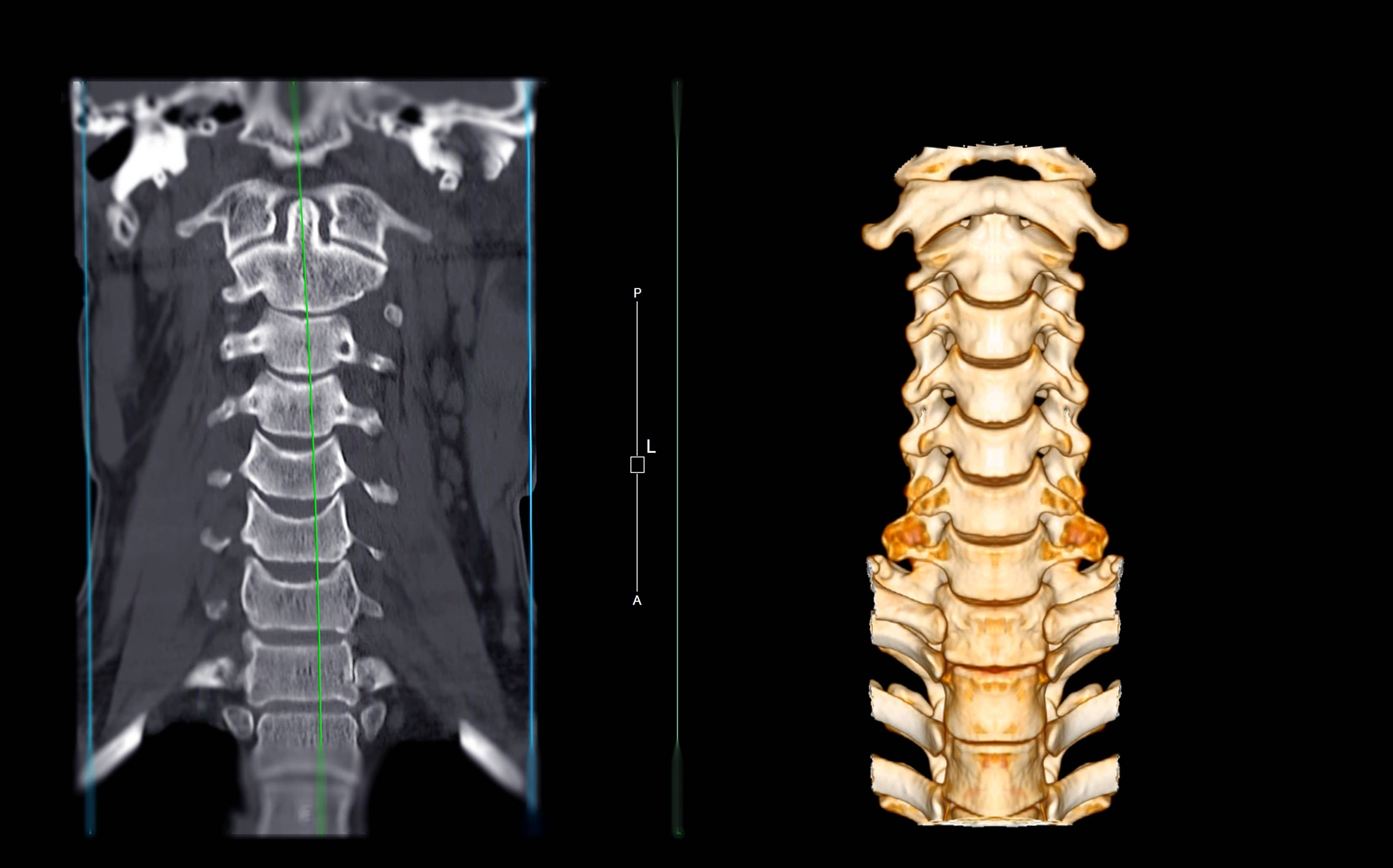 Body Scanner - Single View X-Ray