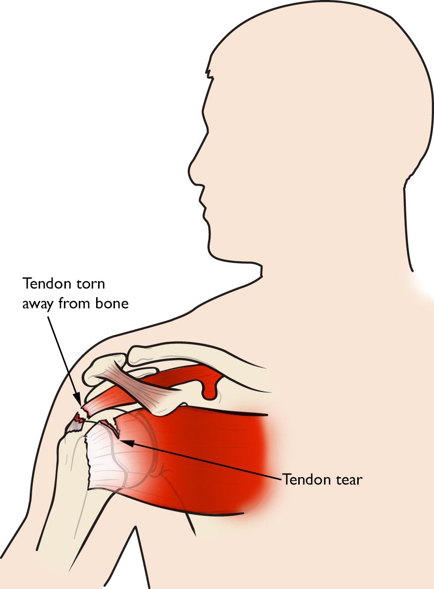 Ilustración de un tendón del manguito rotador arrancado del hueso
