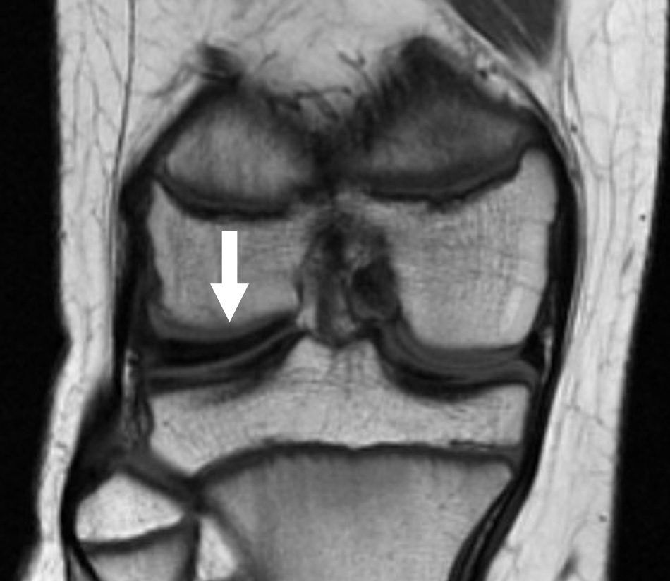 MRI of discoid meniscus