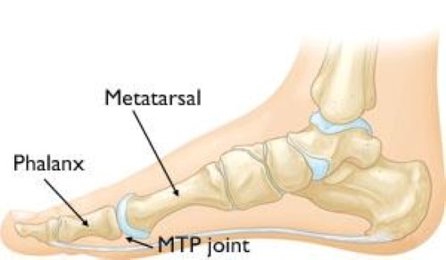 Turf Toe - OrthoInfo - AAOS