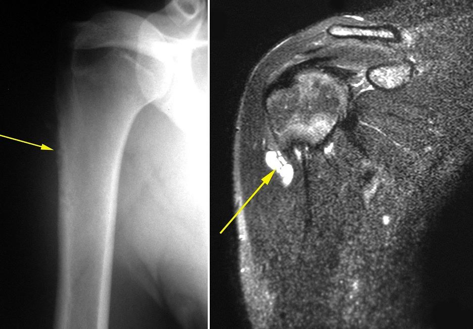 imaging of periosteal chondroma