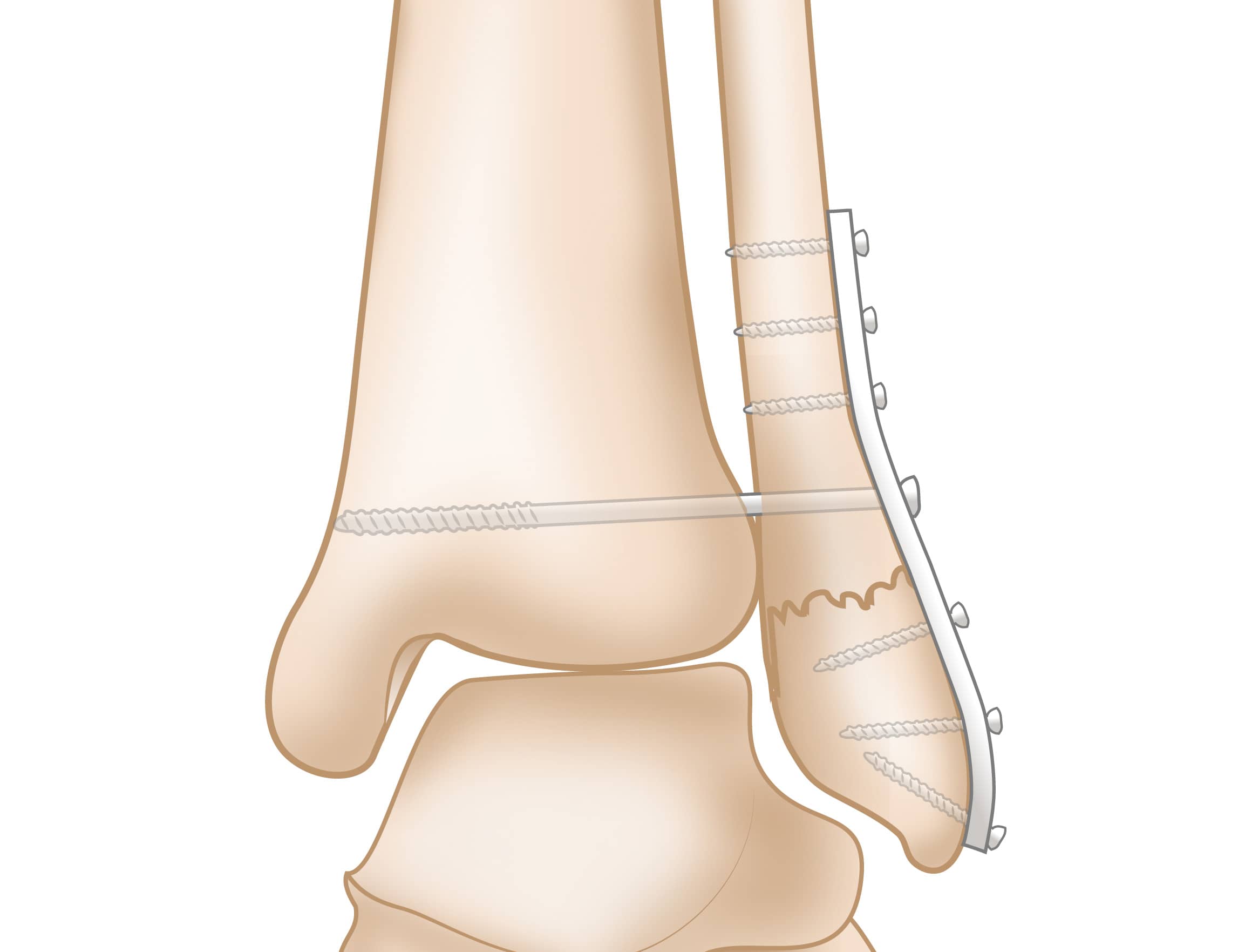 Ankle Sprain or Fracture - Murrell Orthopedics