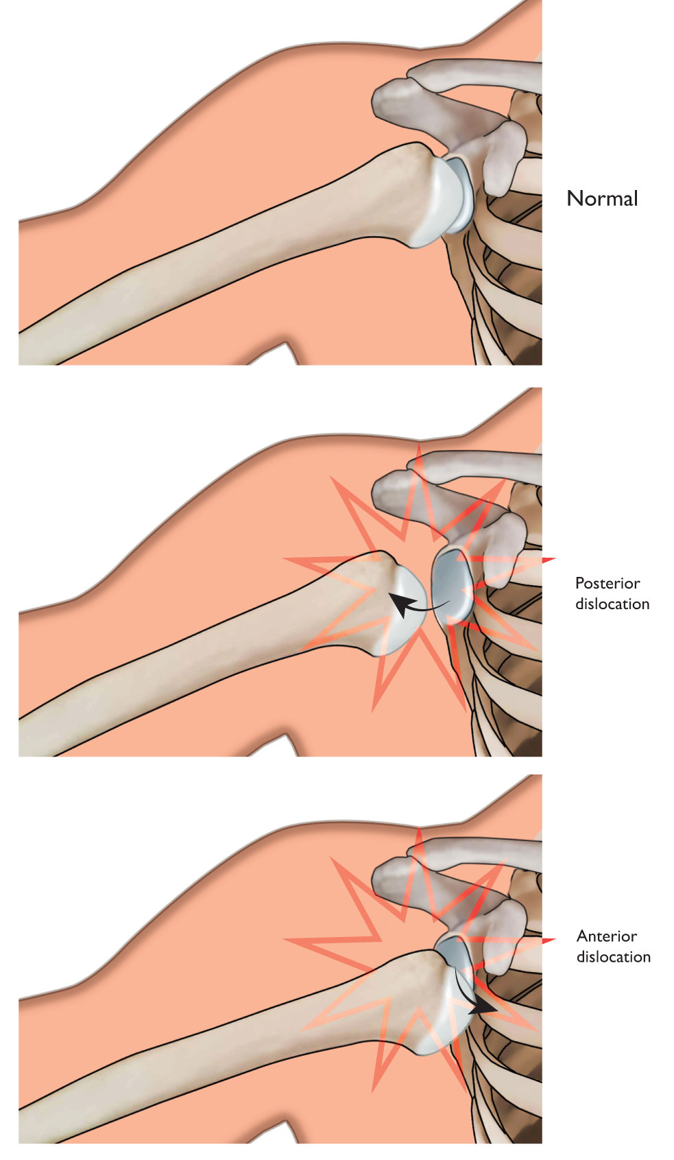 Dislocated shoulder