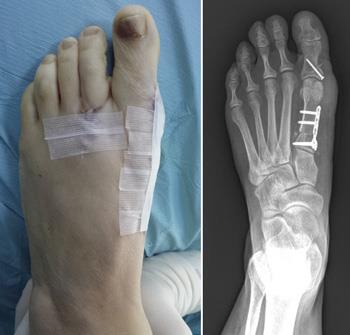 Photo and x-ray of a foot after osteotomy for a bunion