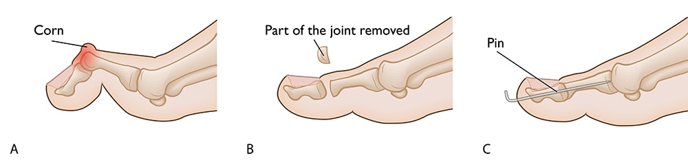 hammer toe in with pin