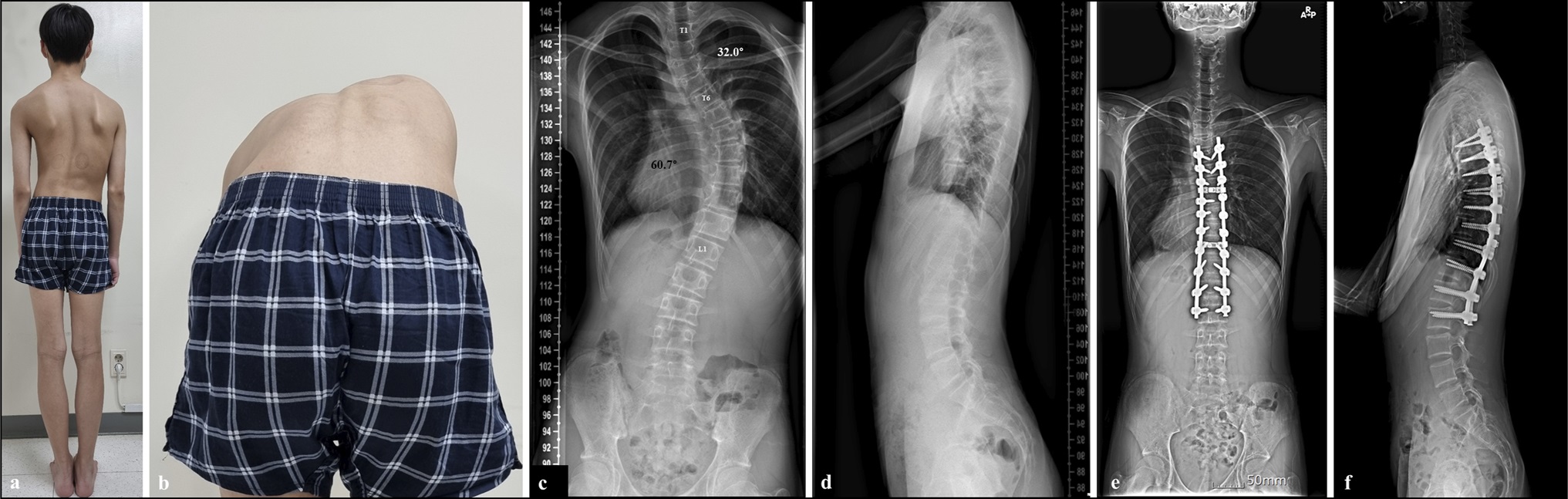 Clinical photos and x-ray of adolescent boy with thoracic idiopathic scoliosis of a patient with scoliosis